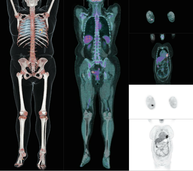 集合PET和CT两种“超能力”的PET-CT，到底是个什么技术？ - 医院新闻 - 河南省胸科医院