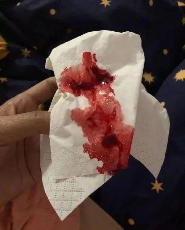 男子得怪病全身大换血