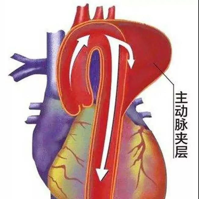 高血脂高血压糖尿病需警惕心血管疾病