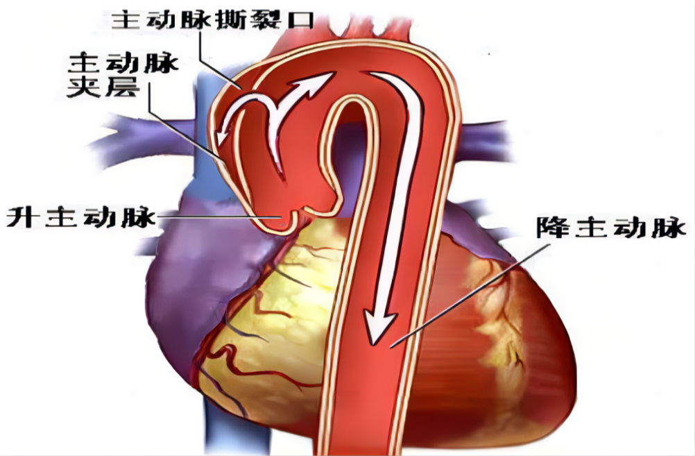 带您了解主动脉夹层--------人体"炸弹" - 健康科普 - 河南省胸科医院