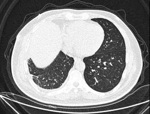 一经确认脓气胸或者脓胸(床旁超声是比较好的选择)需要紧急进行胸腔闭